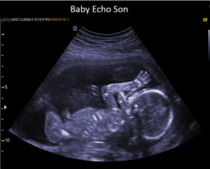 Pretecho Baby Echo Son